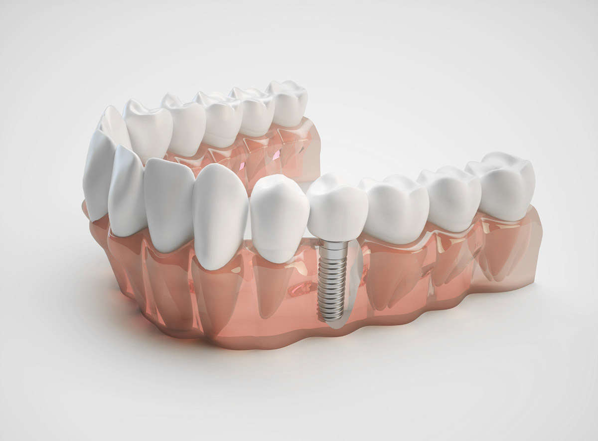 Dental Implants Canadian Association of Oral and Maxillofacial Surgeons